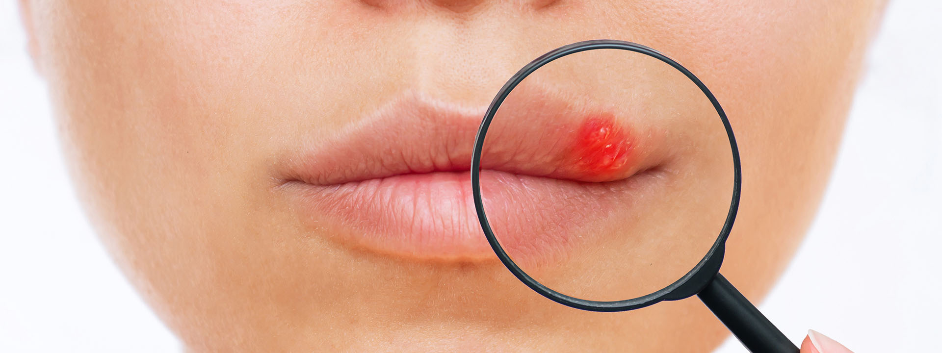 Херпес — Derma-Act блог