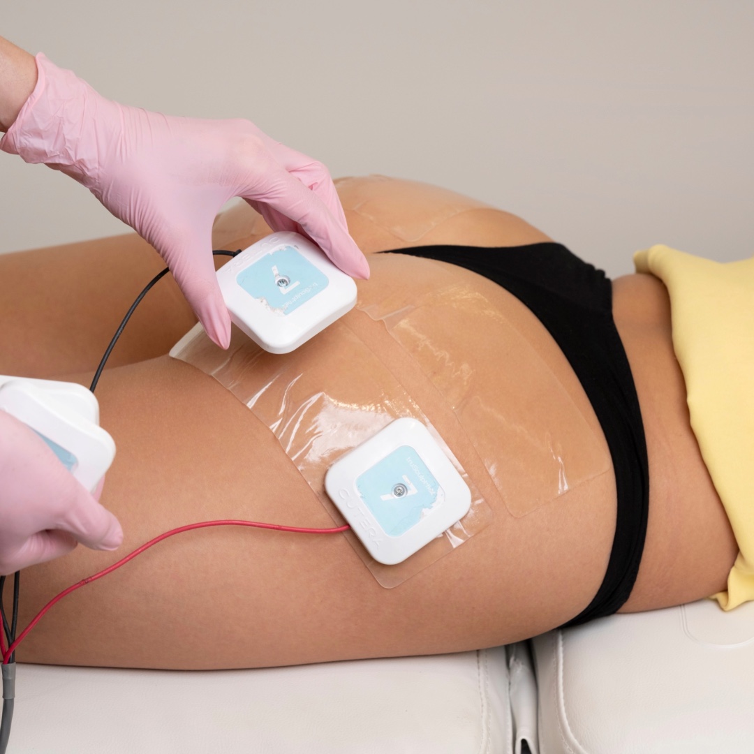 За какво се използва мускулна стимулация с truSculpt® flex?