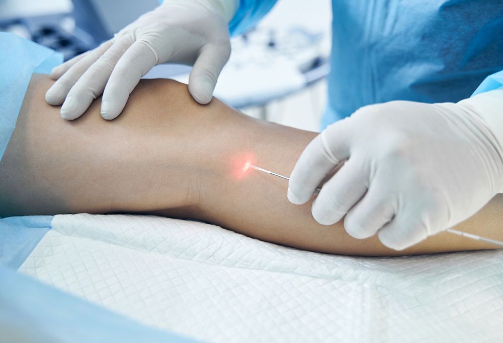 лазер преди процедура