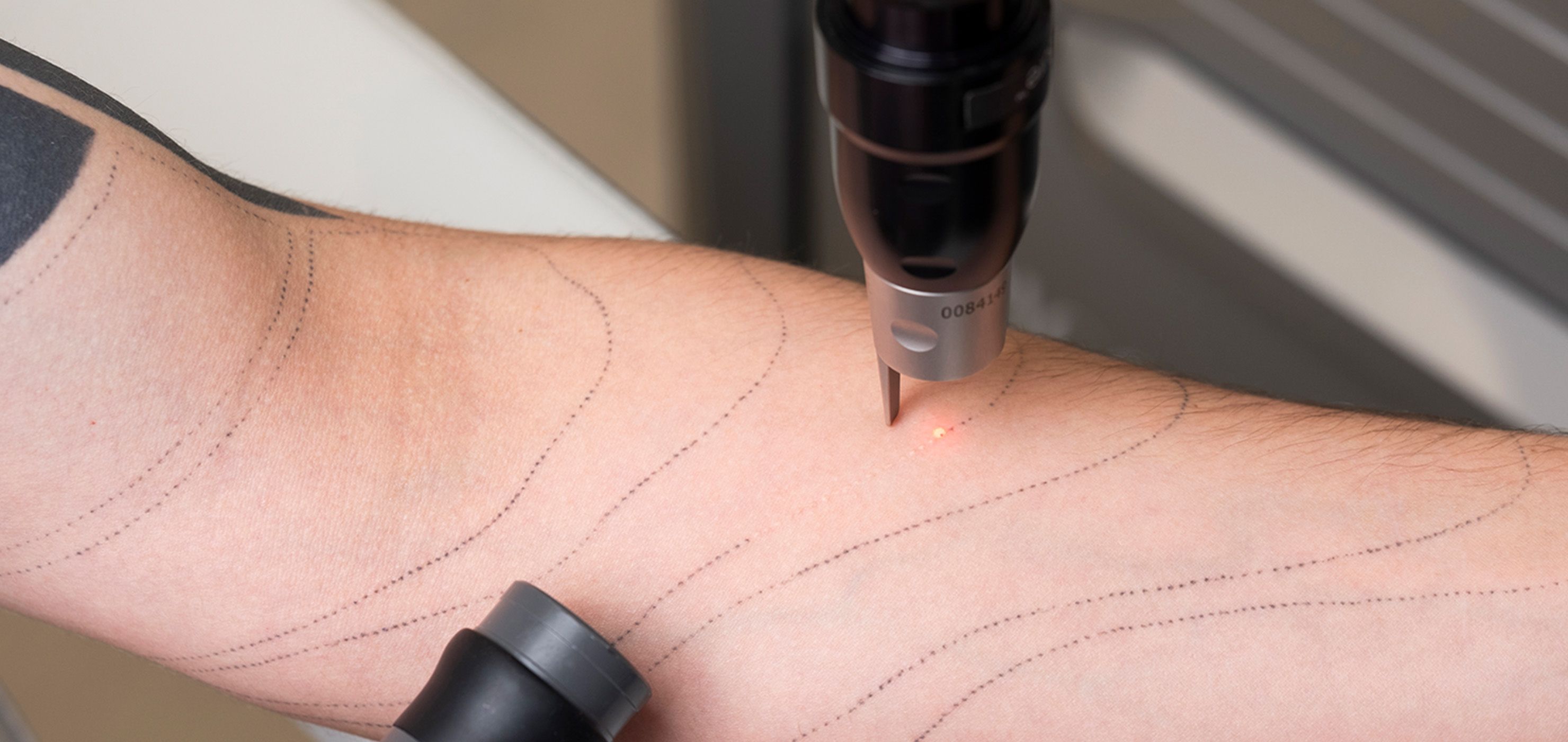 Какъв е ефектът от процедурата?