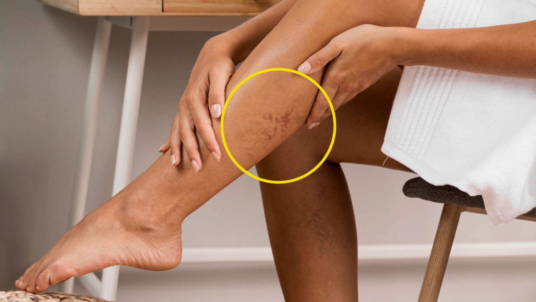 Хронична венозна недостатъчност на долните крайници — Derma-Act блог