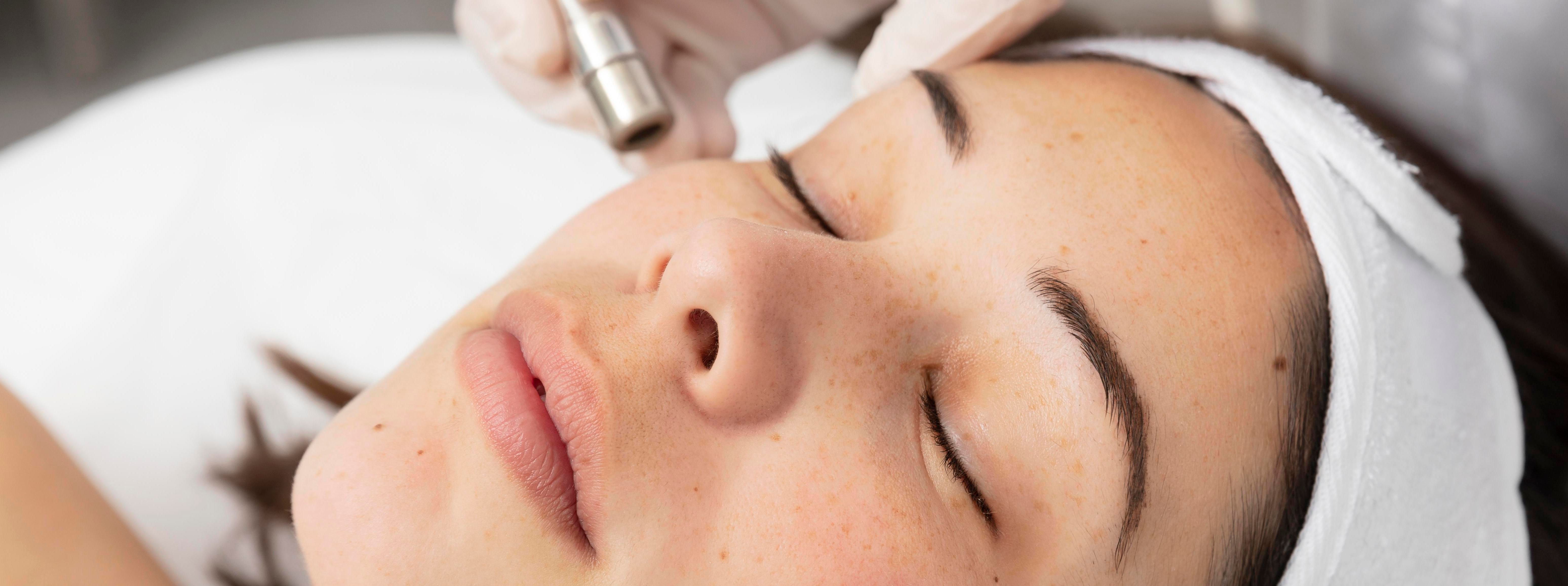 Микродермабразио — процедура в Derma-Act