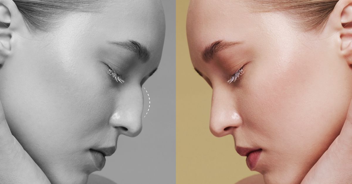 Ринопластика - естетична и функционална хирургия на носа
