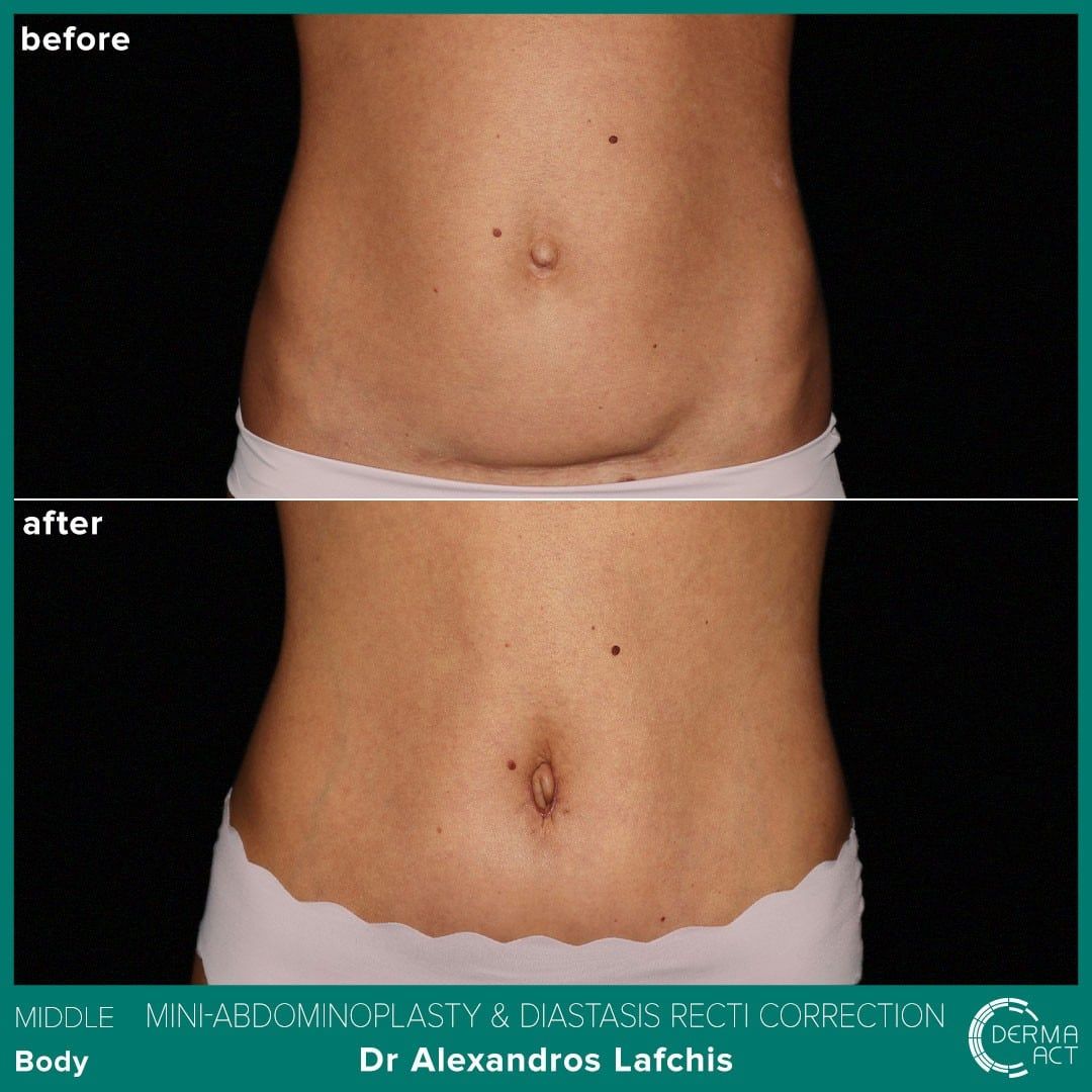 Абдоминопластика 1