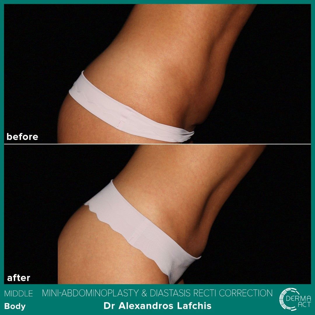 Абдоминопластика 3