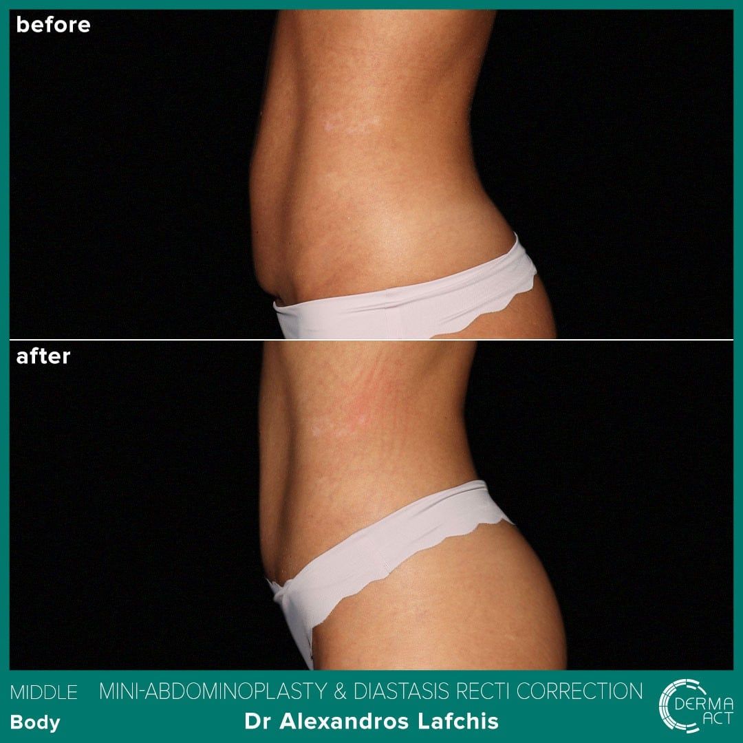 Абдоминопластика 4