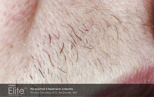 Лазерна епилация на най-ниски цени в София със системата Cynosure Elite+